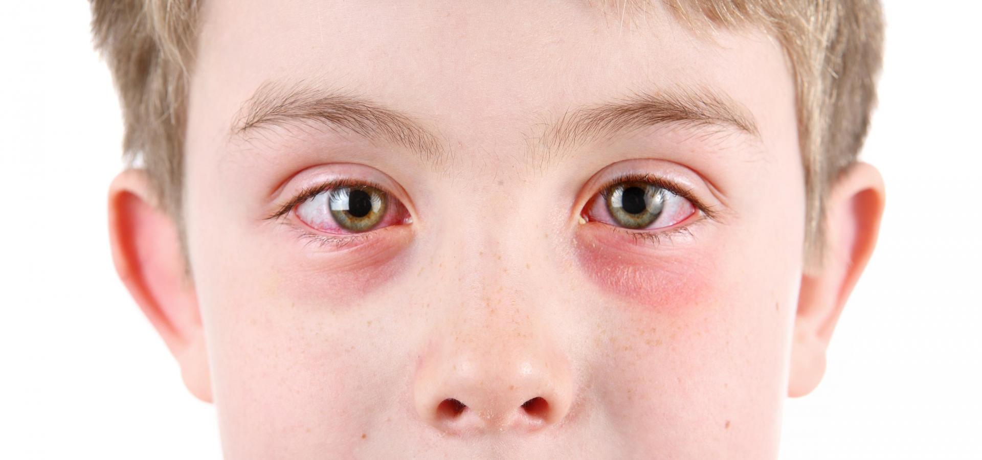 Лечение воспаления глаз у детей и взрослых — Белая Церковь | Шлях Бачити