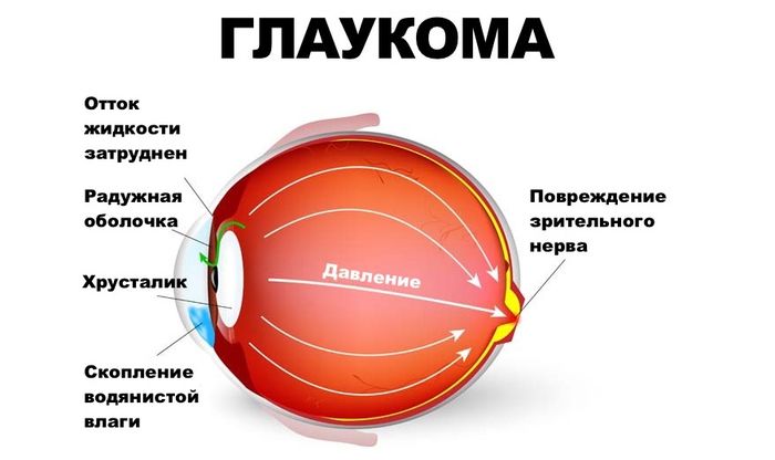 Глаукома: причина и симптомы, методы лечения и профилактики, виды и формы  заболевания