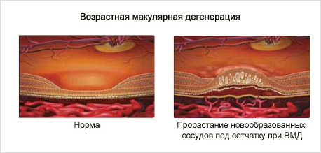 Лечение макулодистрофии сетчатки глаза в ростове thumbnail