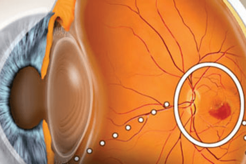 Лечение макулодистрофии сетчатки глаза в ростове